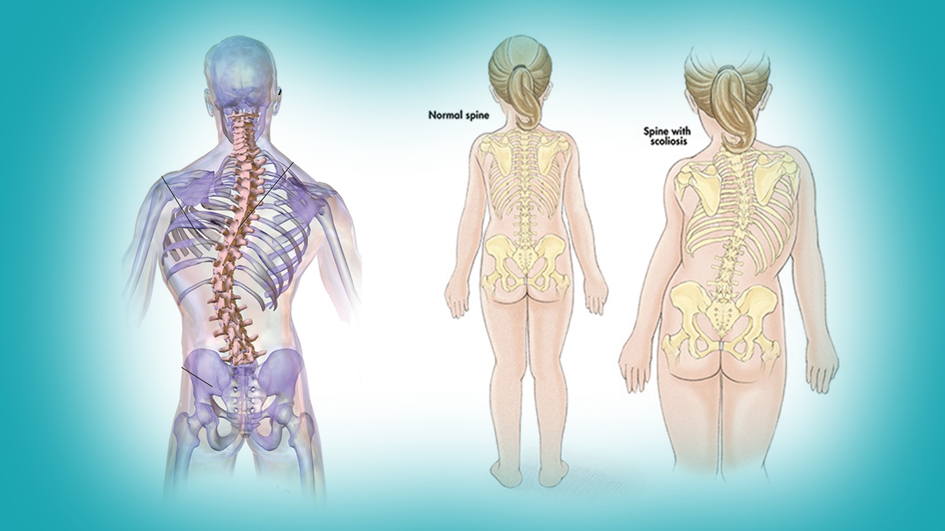 RS Orthopedi & Traumatologi - Scoliosis